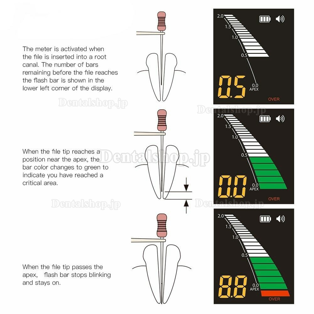 Westcode Mini 歯科用根管長測定器